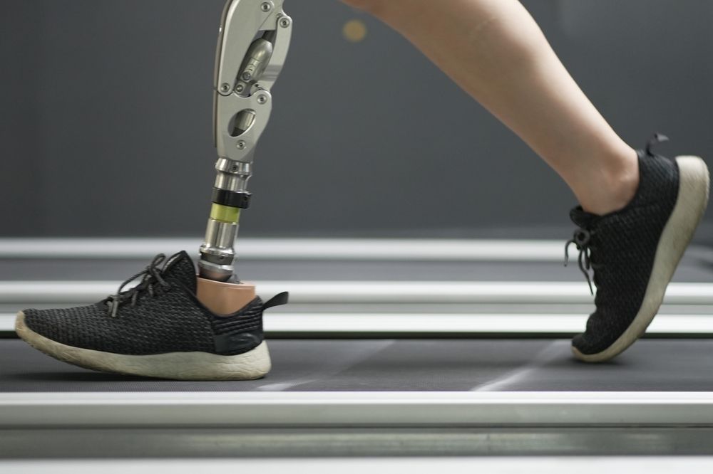 Woman with prosthetic leg using walking on treadmill 